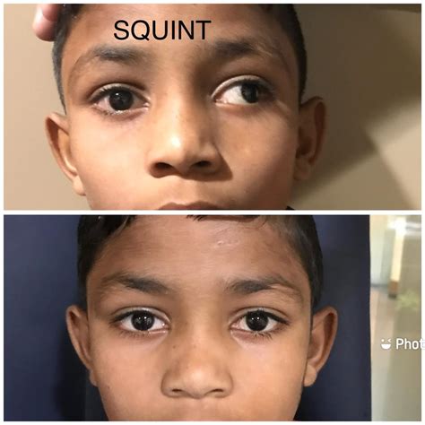 Squint Surgery Specialist in Ahmedabad | Eye Squint Specialist in Ahmedabad