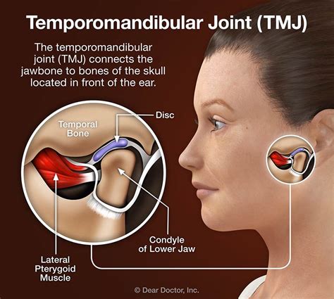 TMJ Disorders