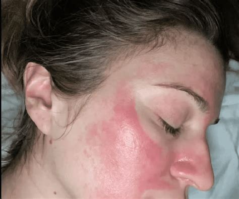 Chemical Peel Gone Wrong | 3 Cases to Learn From - Blushastic