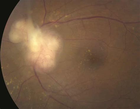 Optic Nerve Disorders Diagnosis | AccessMedicine Network