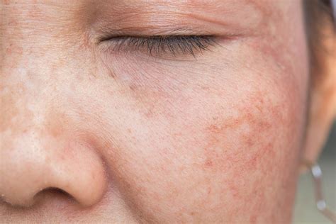 Mottled Skin: Causes Treatment And Prevention | Heidi Salon