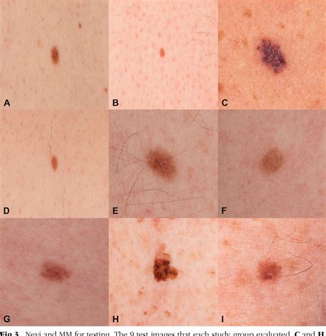 Figure 3 from The role of the ugly duckling sign in patient education ...