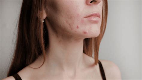 Hormonal Acne Treatment Options: Causes And Natural Remedies