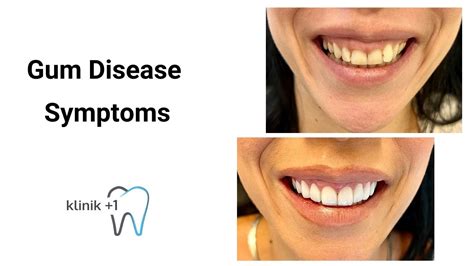 Gum Disease Symptoms - Klinik +1