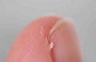 10 Home Remedies for Hangnail - Home Remedies