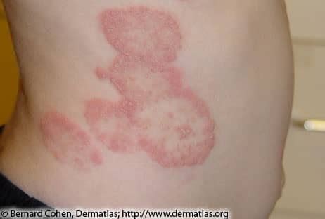 Lyme Disease Rash vs. Other Rashes