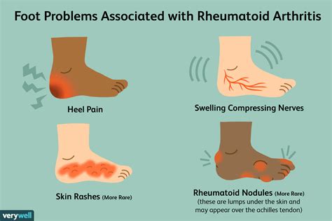 Pain in the Feet As a Symptom of Rheumatoid Arthritis