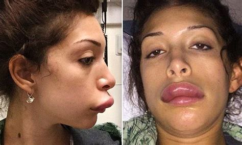 Farrah Abrahams Pays Dearly For Botched Lip Injections | Lip injections, Lips, Injections