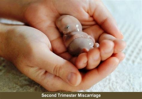 Miscarriage Causes And Treatment - Health And Medical Information