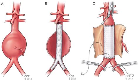 Abdominal Aortic Aneurysm Repair