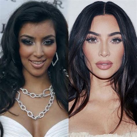 Kim kardashian before and after | Celebrity surgery, Celebrity plastic ...