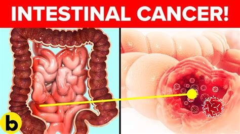 8 Signs Of Intestinal Cancer That You Should Be Aware Of - YouTube