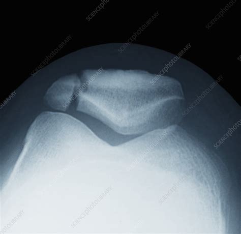 Fractured patella, x-ray - Stock Image - C021/1939 - Science Photo Library