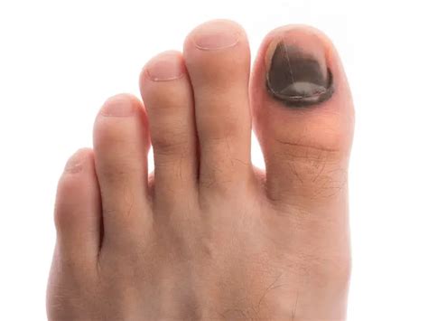 Black Toenail: 5 Common Causes and Treatment (A Helpful Guide)