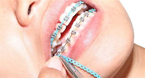 Braces Removal Process: Here’s What You Need to Know - Istoso Visto ...