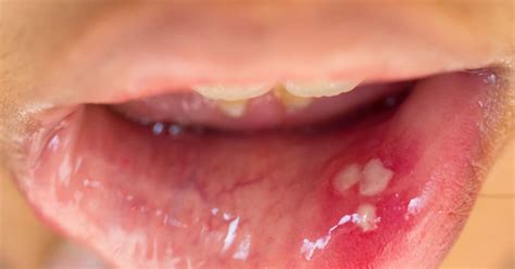 HPV in the mouth: Symptoms, causes, and treatment
