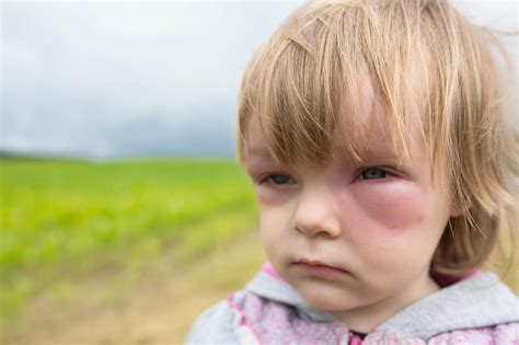 Anaphylaxis Face - Anaphylaxis | Allergy Medik - Anaphylaxis, also referred to as an ...