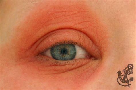 Swollen Eyelid Due To Makeup Allergy | Saubhaya Makeup