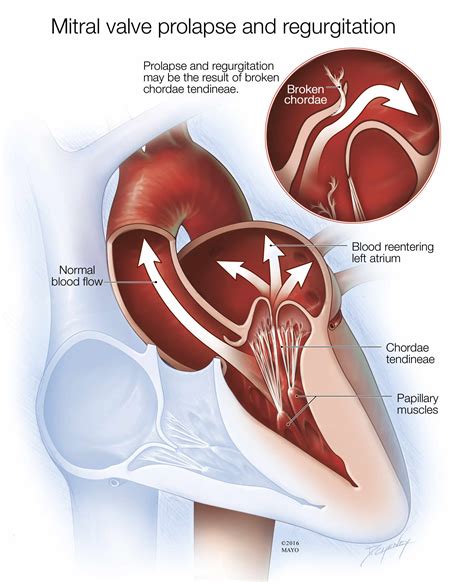 Mayo Clinic Q and A: Vast Majority of People With Mitral Valve Prolapse ...