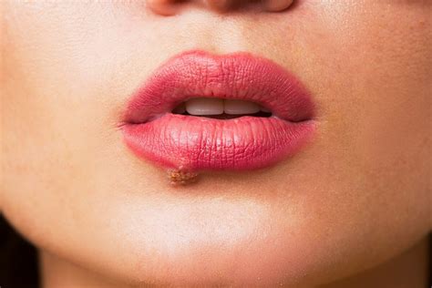 Lippenherpes - Hausmittel, Bilder & Infektion - Was wirklich hilft!