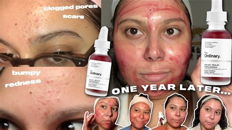 the ordinary peeling solution ONE YEAR results and review - YouTube