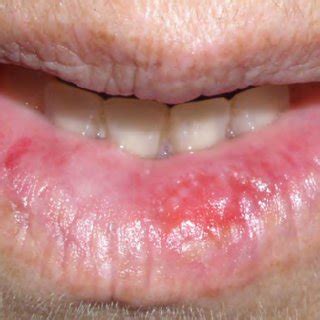 Squamous Cell Lip Cancer Pictures | Sitelip.org