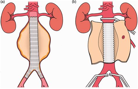 Abdominal Aortic Aneurysm Repair