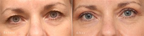 Upper Eyelid Surgery Photos | Princeton, NJ | Patient 8225