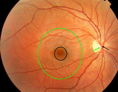 Normal Retinal Anatomy - The Retina Reference