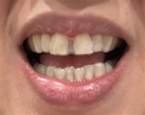 Has anyone decided to keep a front tooth gap? : r/Invisalign