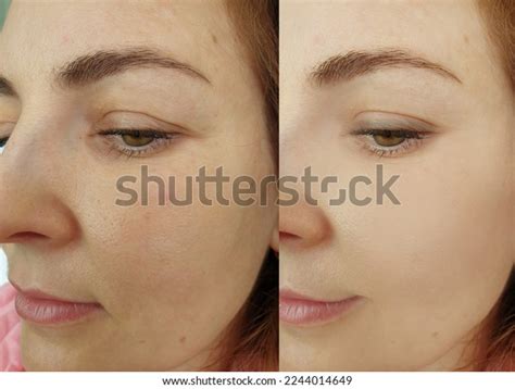 Woman Face Wrinkle Before After Treatment Stock Photo 2244014649 ...