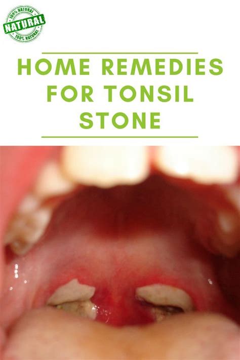 Dental Health, Dental Care, Tonsil Stones, Tonsil Stone Removal, Tonsil ...