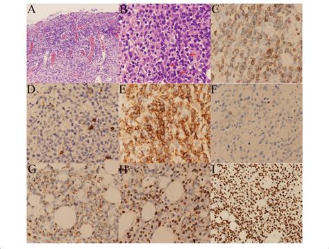 | Histological and immunohistochemical pictures of the lymphoma. (A ...