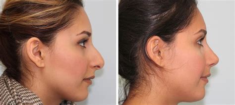 rtkjejkt | Rhinoplasty recovery, Nose surgery, Nose job