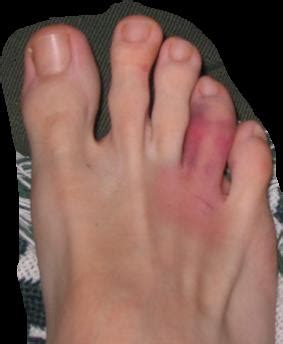 Treatment of Toe Injuries : Broken, Sprained, Fractured, Stubbed, or Jammed: Symptoms of a ...