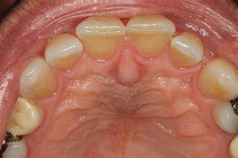 Nasopalatine duct cyst - Definition of Nasopalatine duct cyst