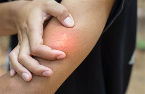 Common Bug Bites and Stings: Symptoms & Treatments