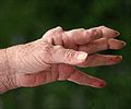Study Offers Insights Into Treatment Of Rheumatoid Arthritis