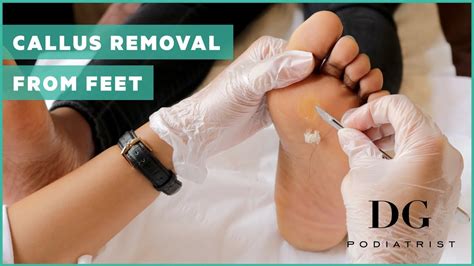 Callus removal from feet: balls of feet - YouTube