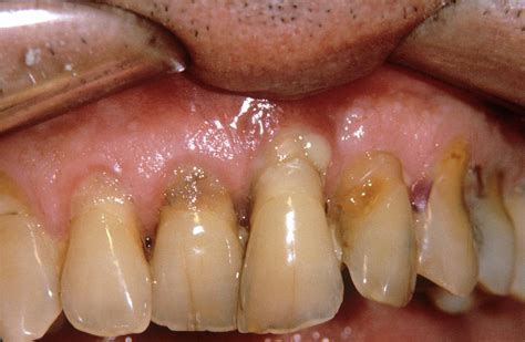 Abscess In Severe Gum Disease Photograph by Dr. J.p. Casteyde/cnri