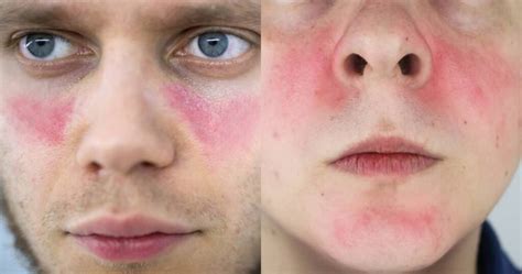 Lupus Vs Rosacea: Differences, Strong Causes And More - 2024