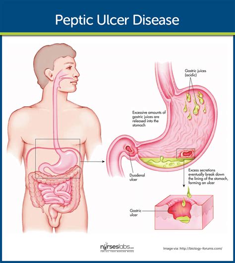 Peptic Ulcer Disease Nursing Care and Management - Nurseslabs