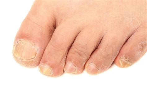 Understanding Fungal Nail Infections and Best Treatment Options