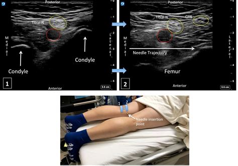 How I Do It: Infiltration Between Popliteal Artery and Capsule of Knee ...