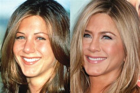 Jennifer Aniston's Plastic Surgery Journey - Vanity