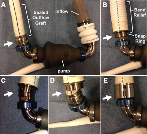 Evaluation of Bend Relief Disconnection in Patients Supported by a HeartMate II Left Ventricular ...