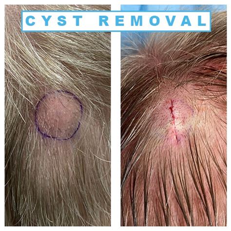 Cyst removal - Midland Skin