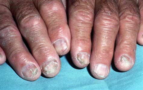 How To Get Rid Of Green Fungus On Fingernail at kennethajenkins blog