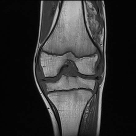 Synovitis - knee | Radiology Case | Radiopaedia.org