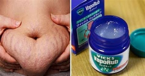 7 Natural Ways To Remove Stretch Marks Fast At Home | Vicks vaporub, Vicks vapor rub, Vicks vapor